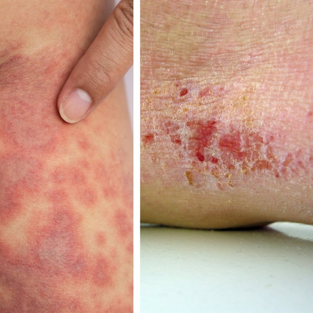 Renew Eczema Relief COLLOIDAL OATMEAL, USP-GRADE PETROLATUM PLANT-BASED GLYCERIN - Picture 7 of 16